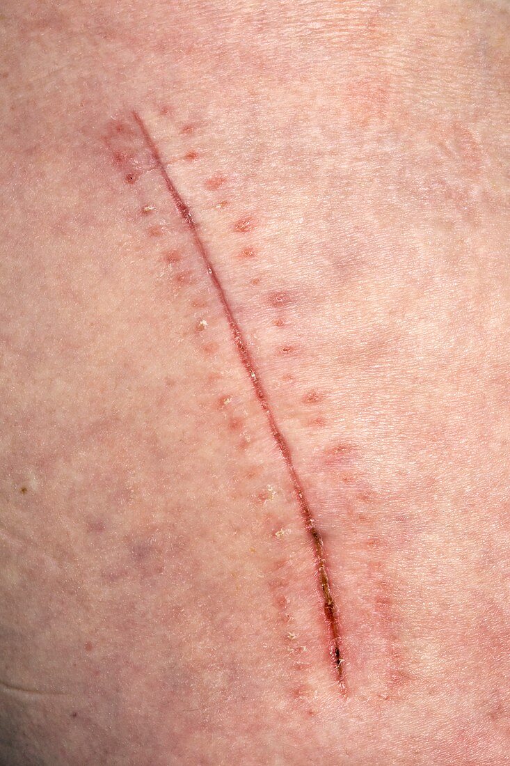 Healed surgical wound from hip replacement surgery