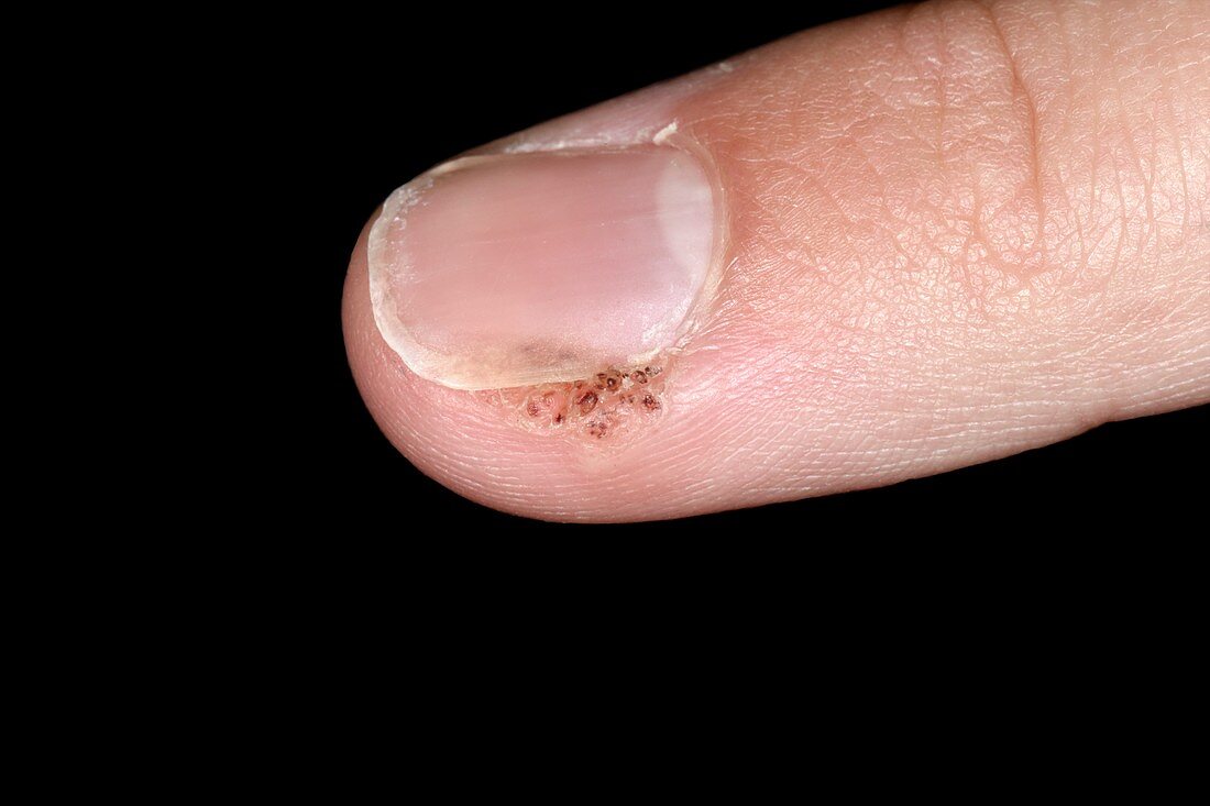 Wart on finger