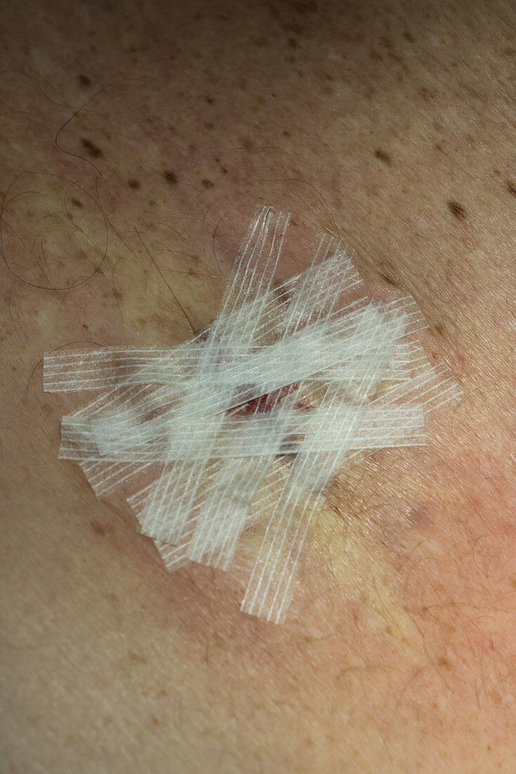 Scar after melanoma removal