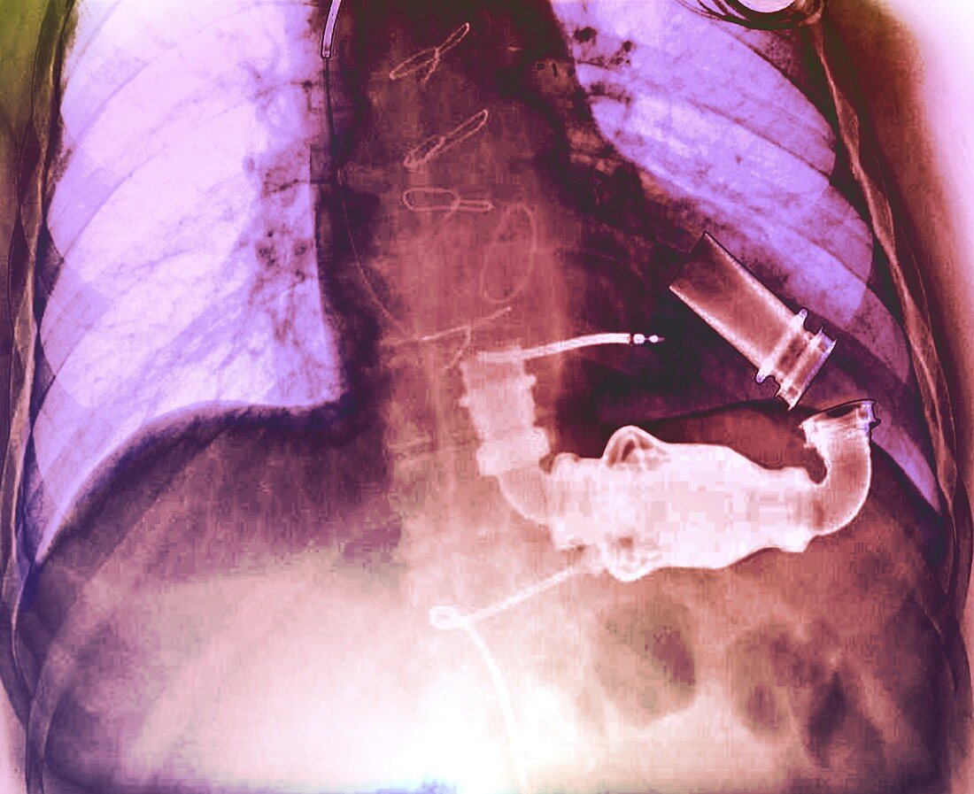 Ventricular assist device, X-ray