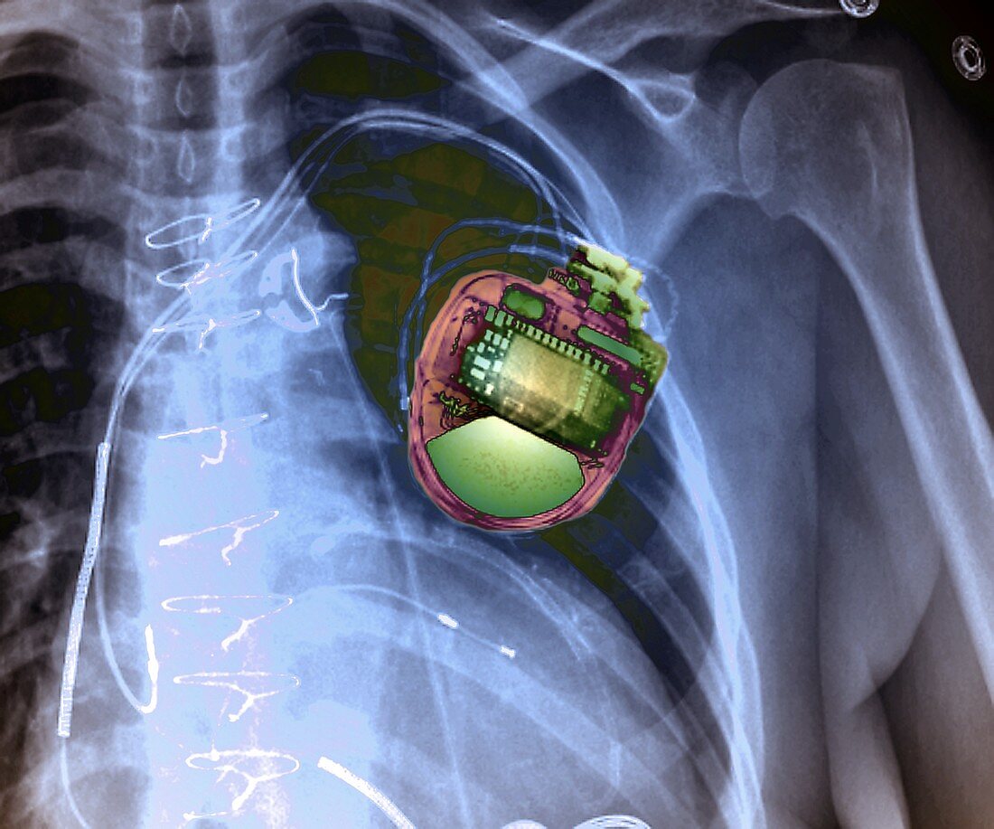 Pacemaker, X-ray