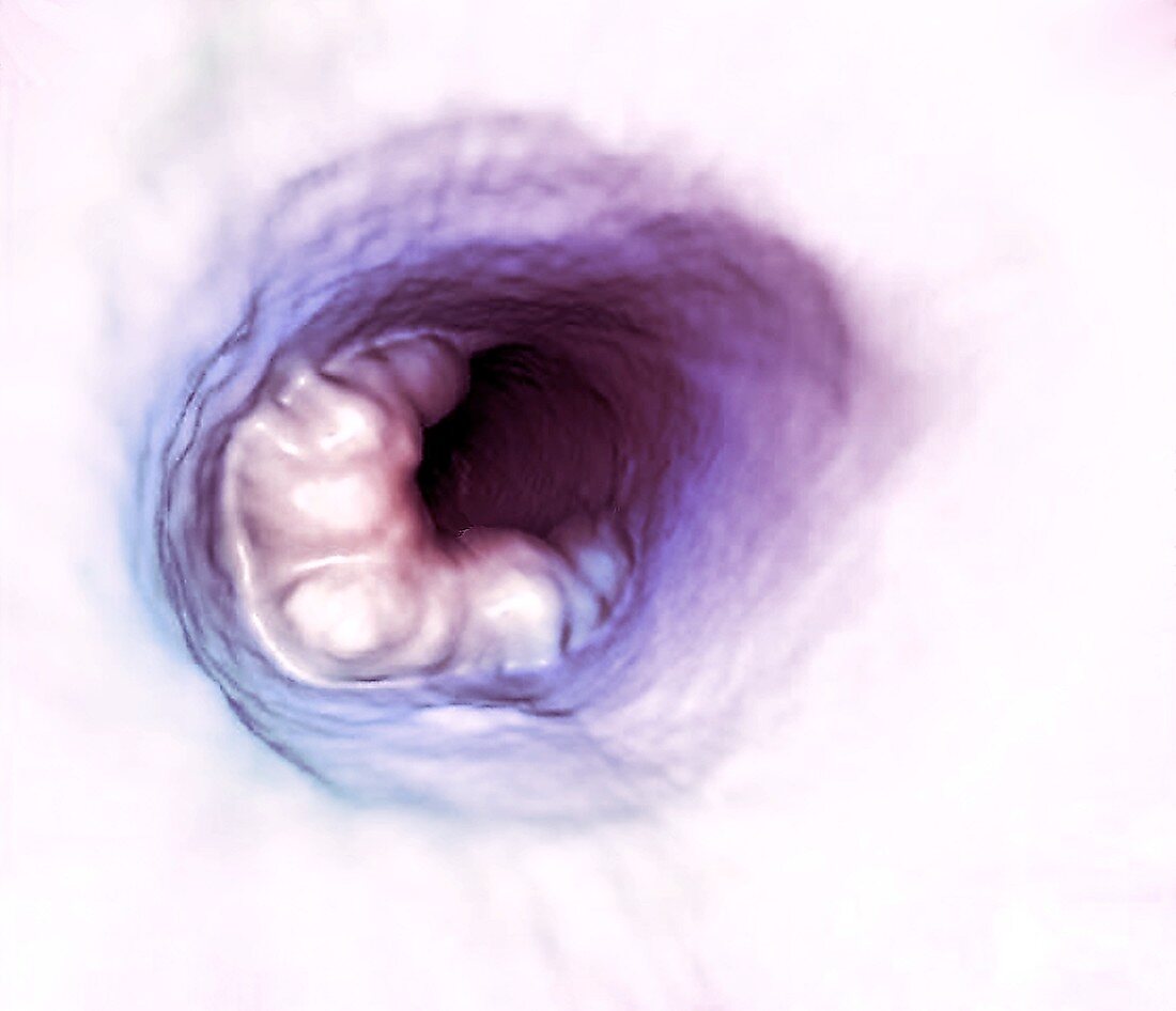 Colon cancer, 3D CT scan