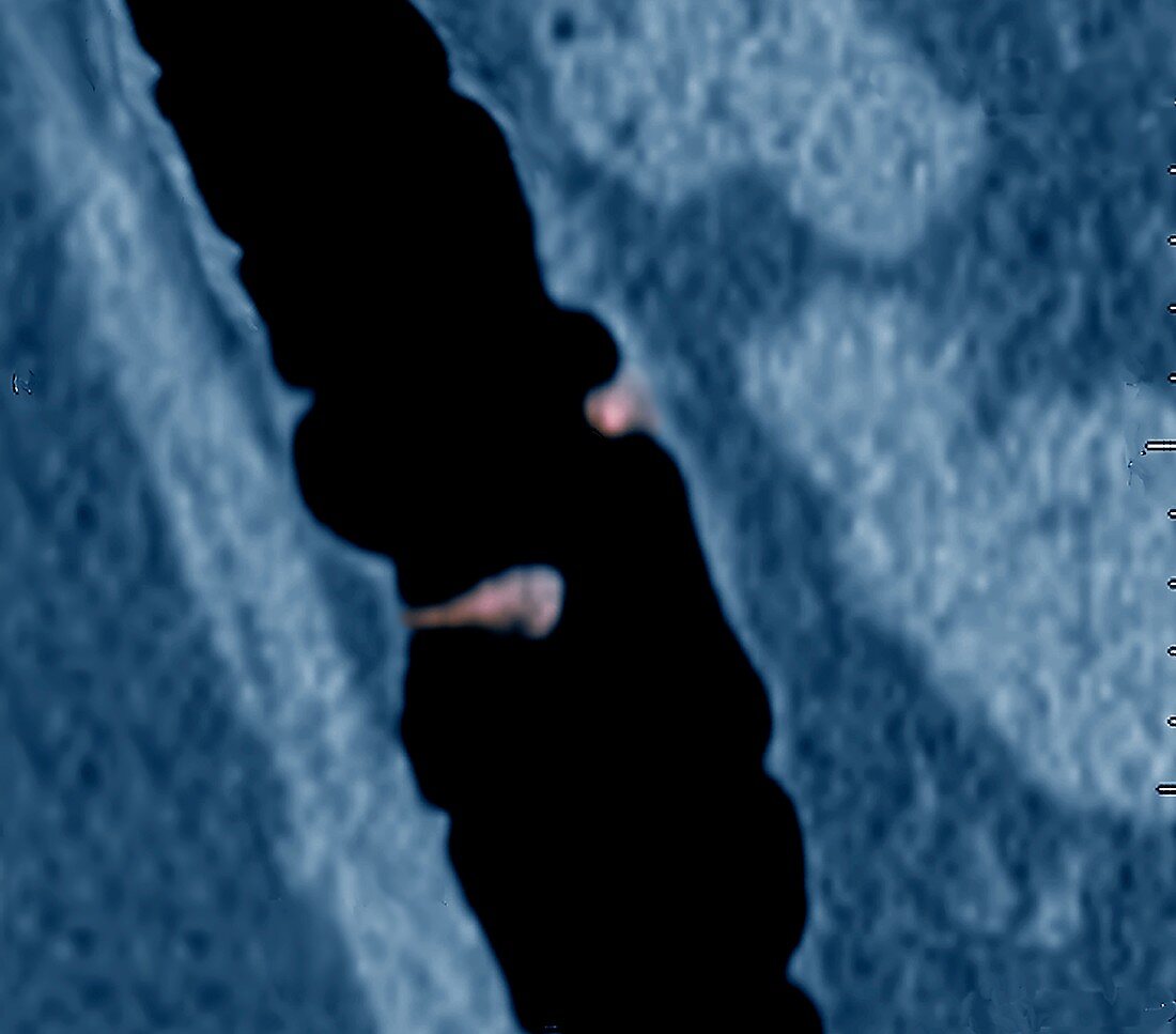Colorectal polyp, CT scan