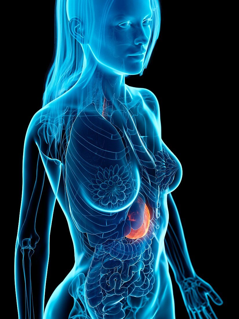 Diseased stomach, illustration