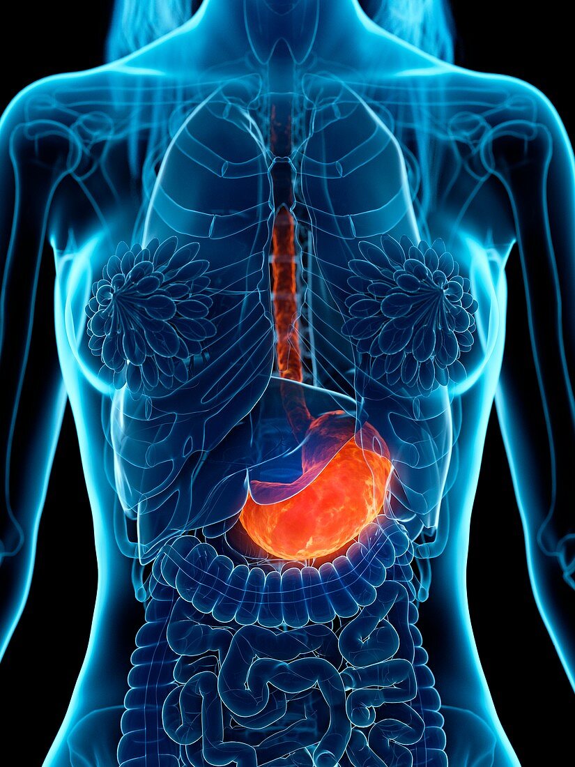 Diseased stomach, illustration