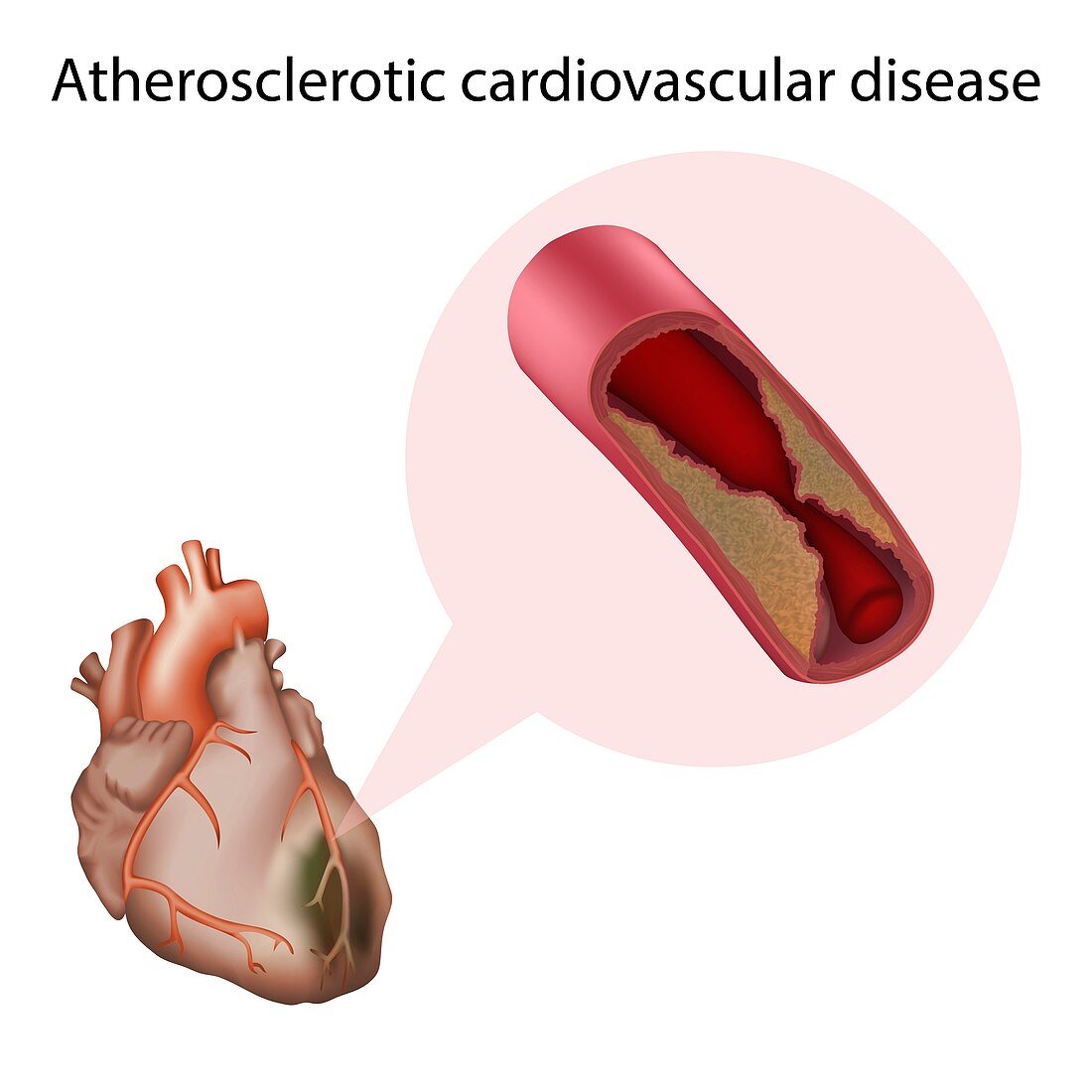 Atherosclerotic cardiovascular disease, illustration