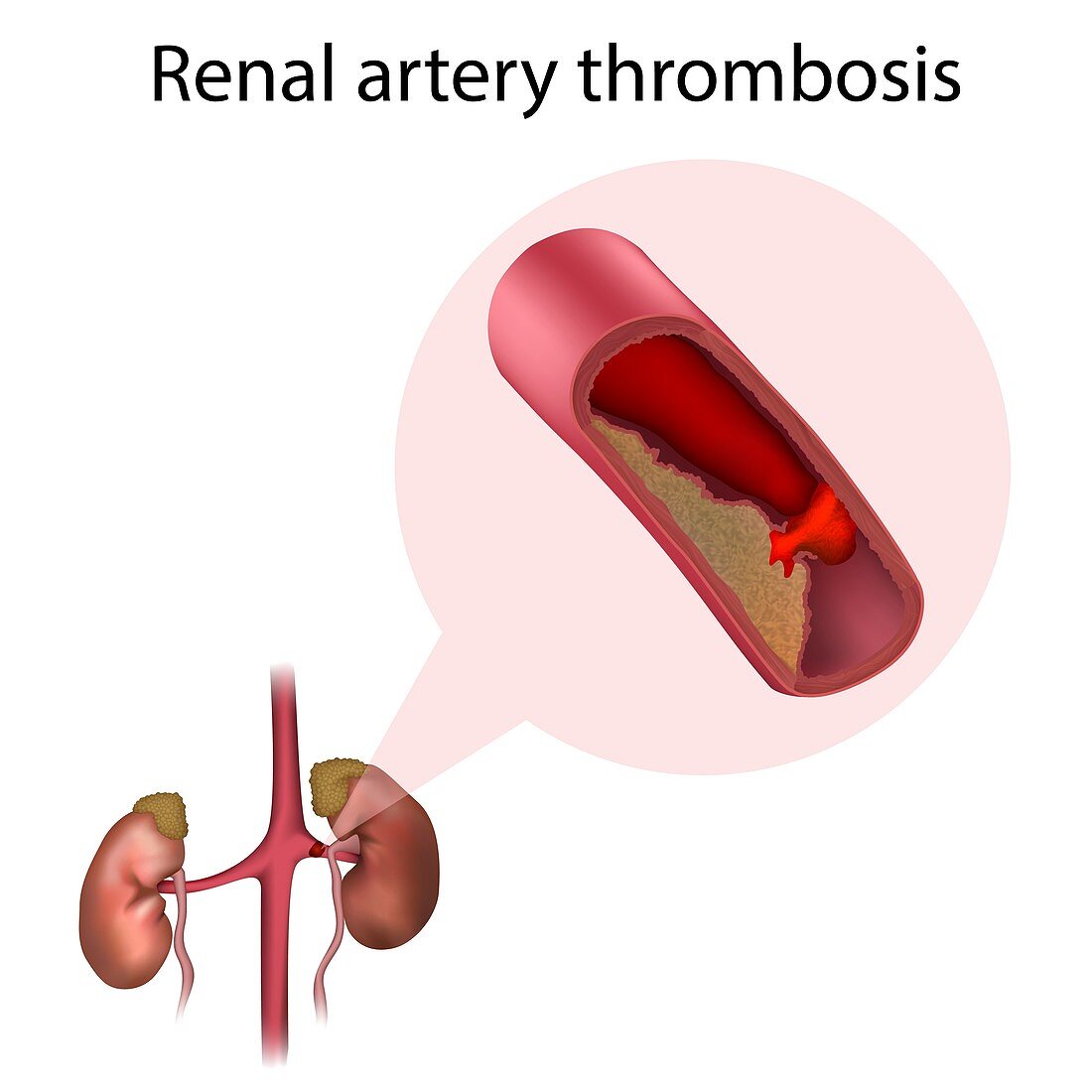 Renal artery thrombosis, illustration