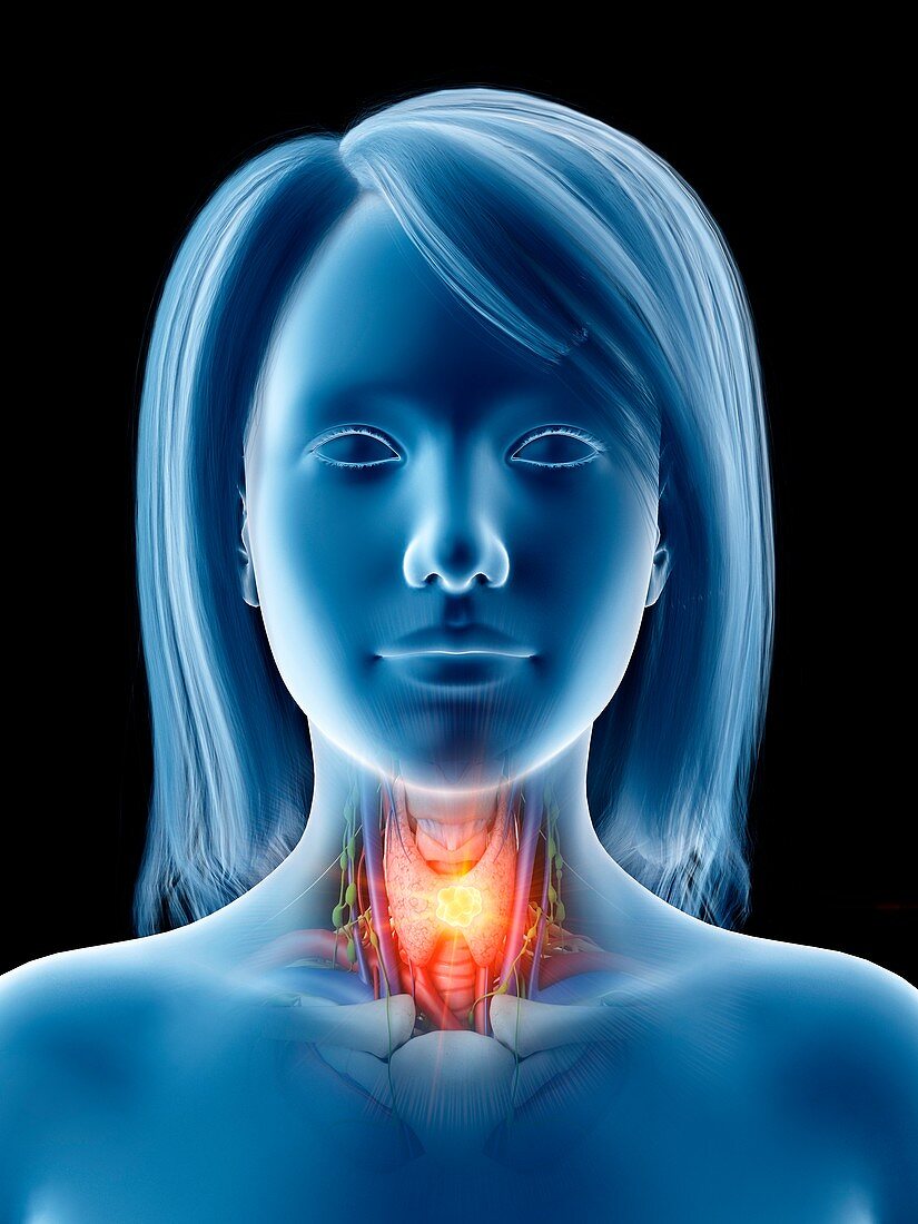 Thyroid cancer, conceptual illustration