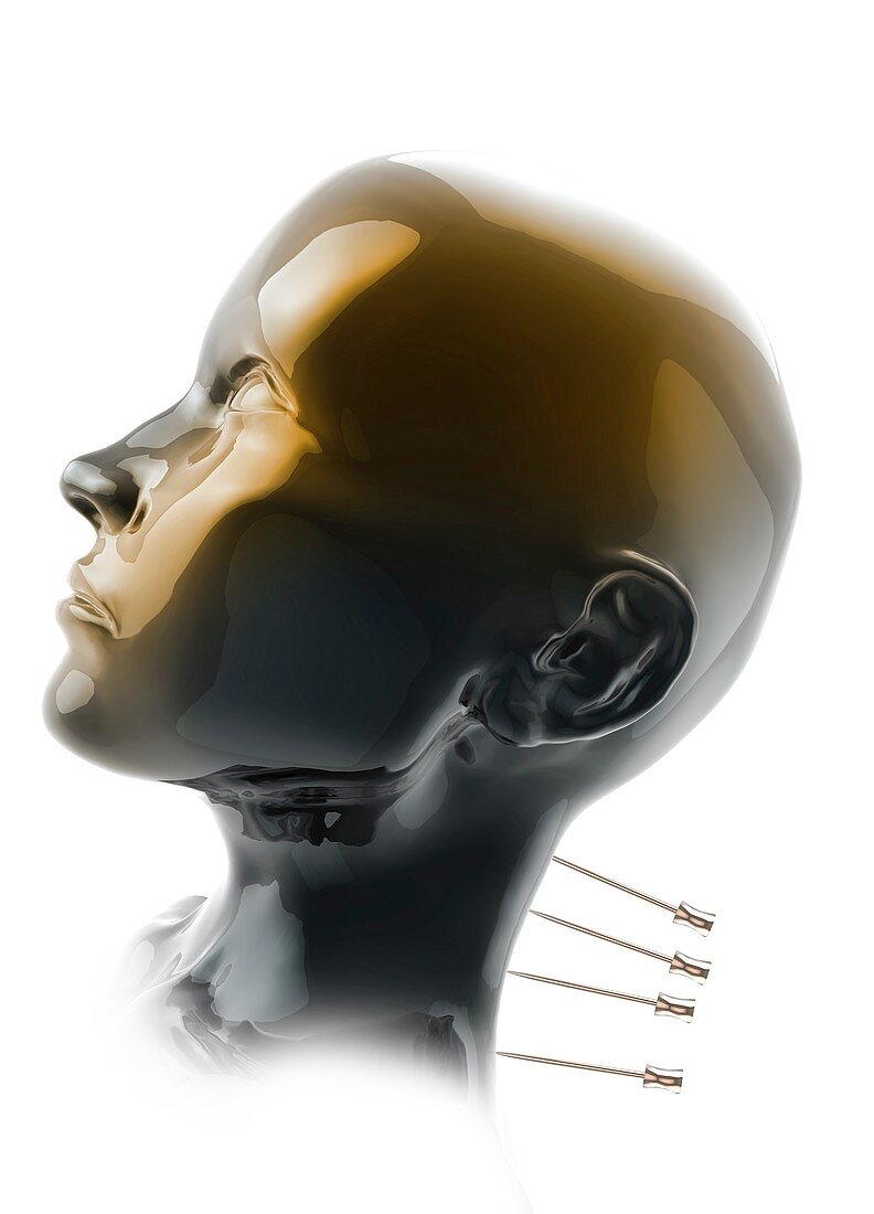 Acupuncture in human neck, illustration