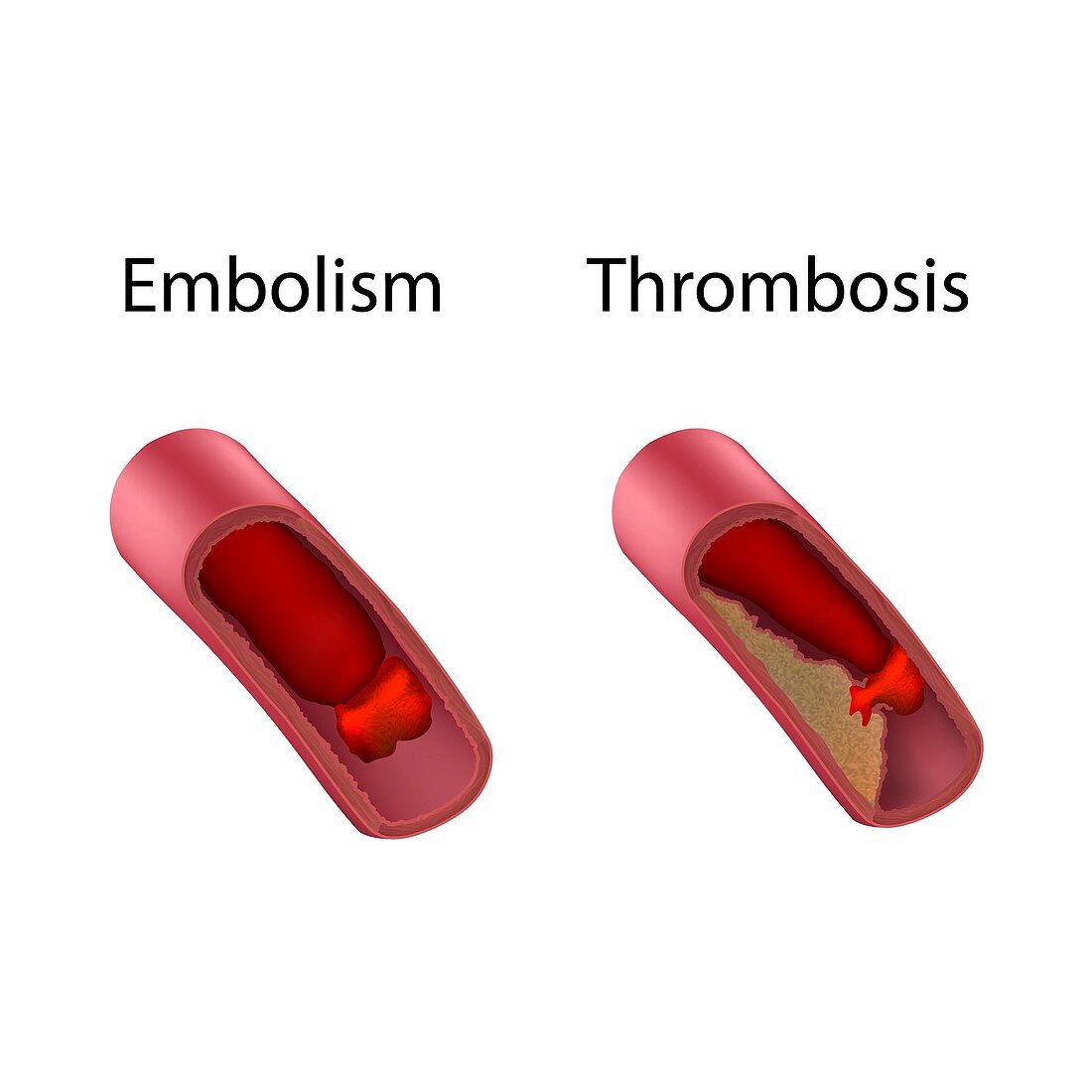 Embolism and thrombosis, illustration