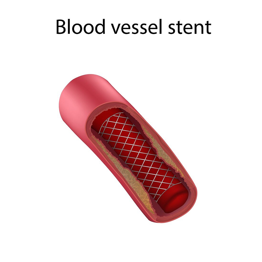 Blood vessel stent, illustration