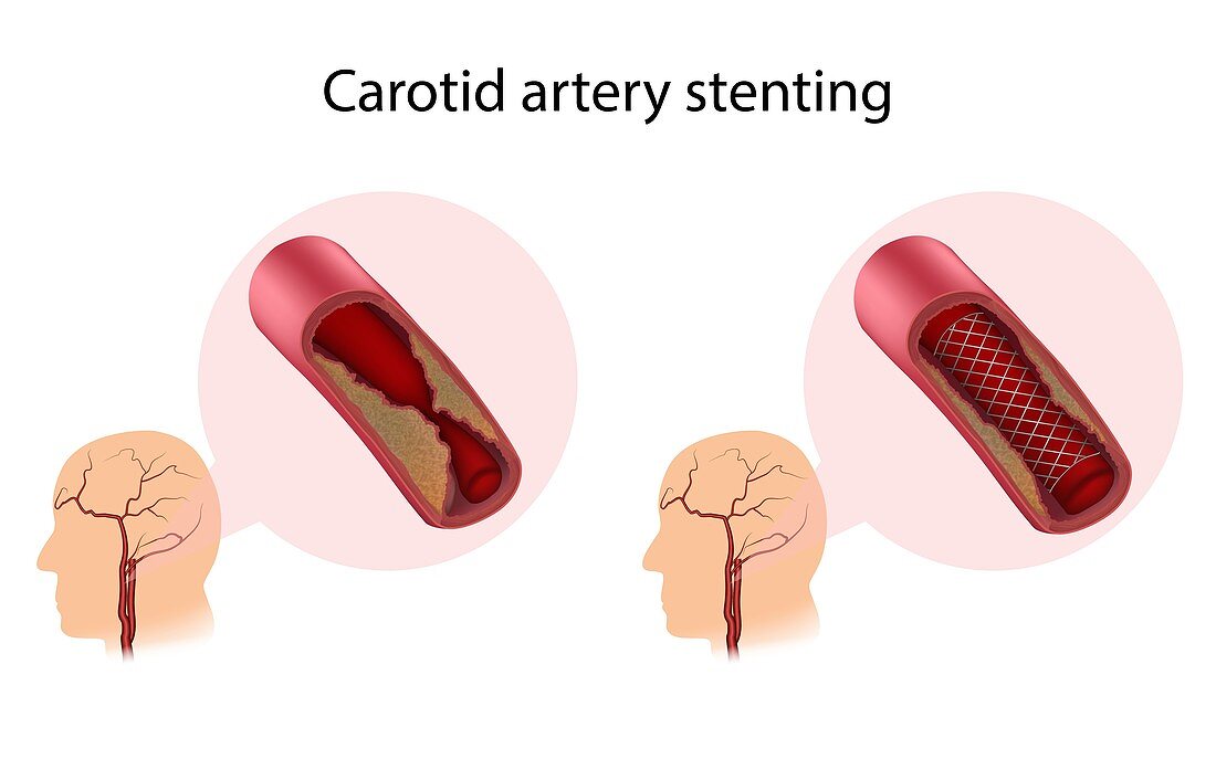 Carotid artery stenting, illustration