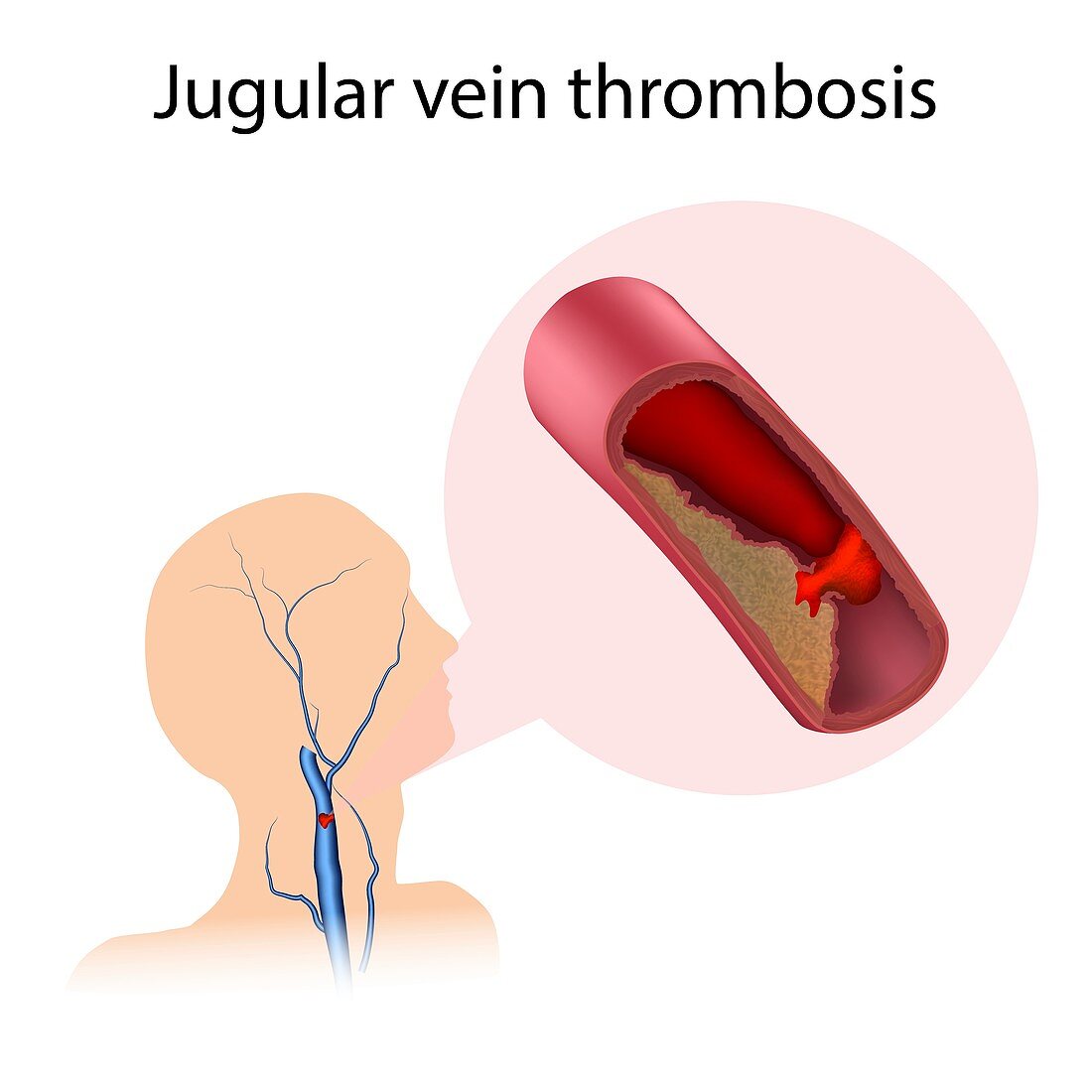 Jugular vein thrombosis, illustration
