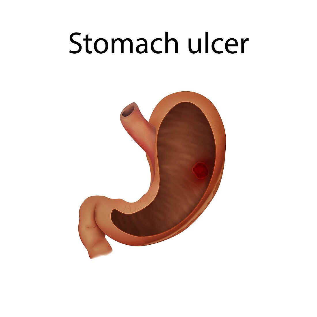 Stomach ulcer, illustration