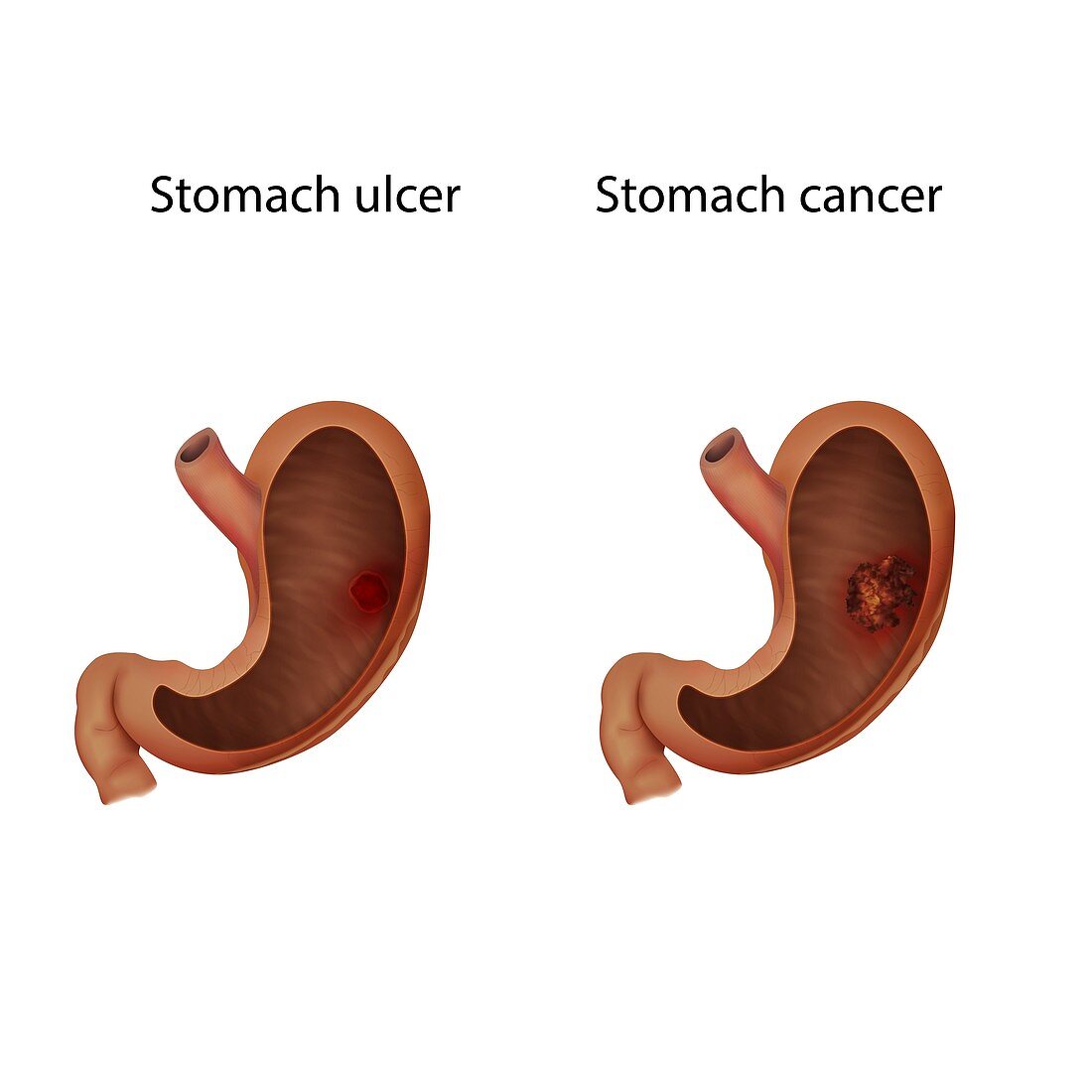 Stomach ulcer and stomach cancer, illustration
