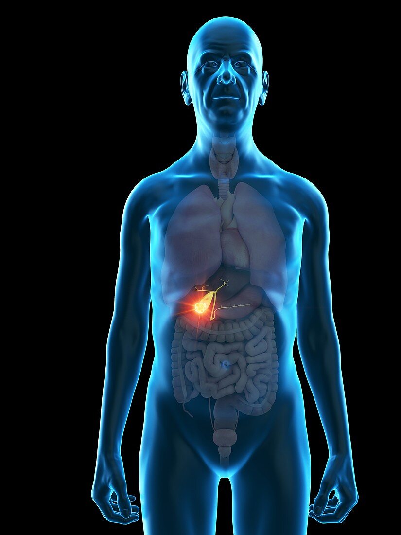 Illustration of an old man's gallbladder tumour