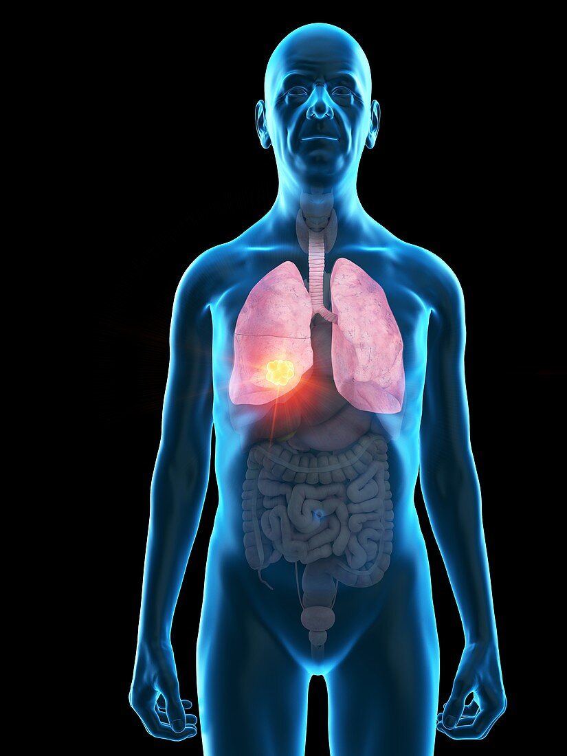 Illustration of an old man's lung tumour