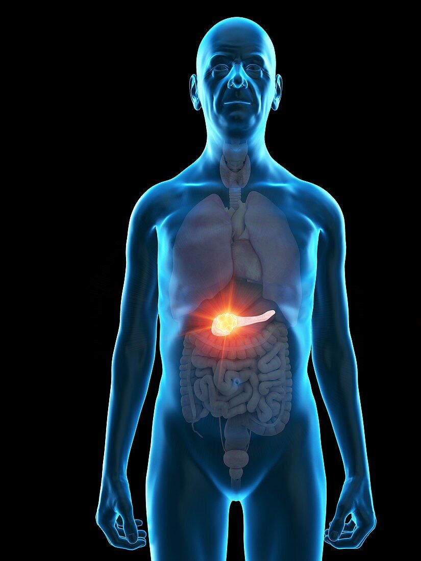 Illustration of an old man's pancreas tumour