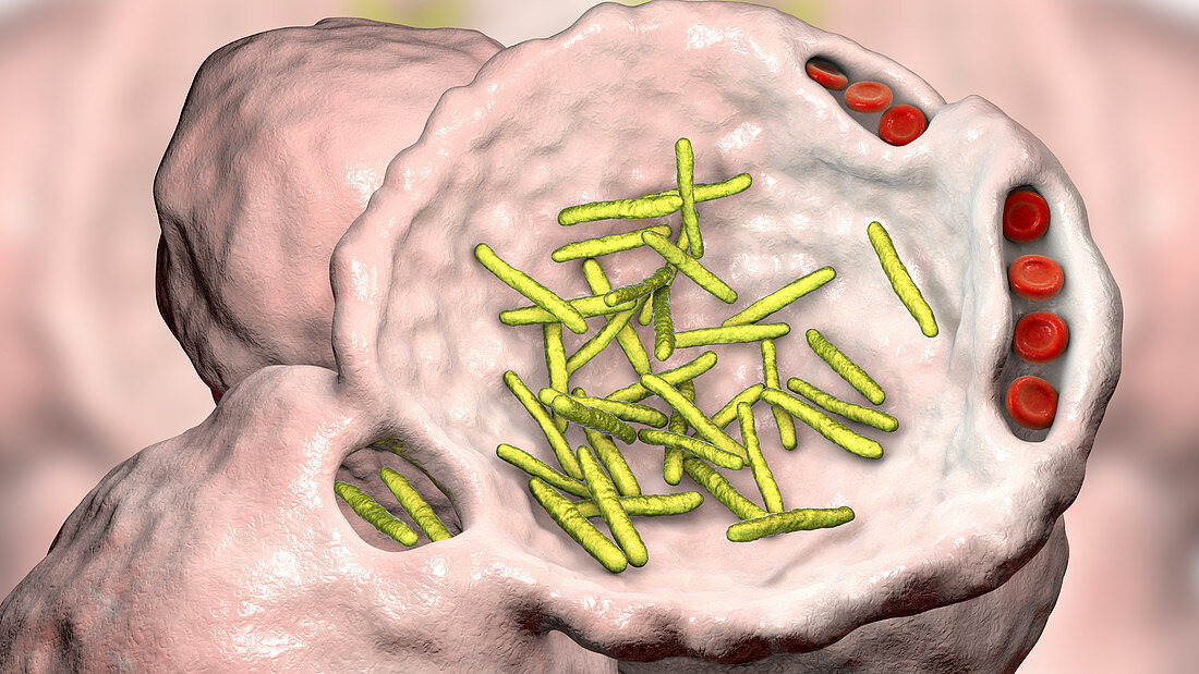 Bacterial pneumonia, illustration