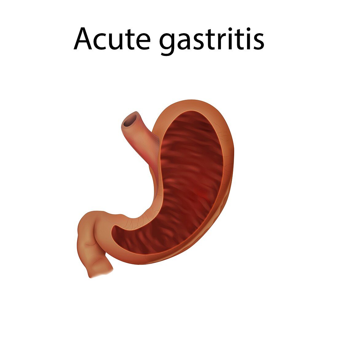 Acute gastritis, illustration
