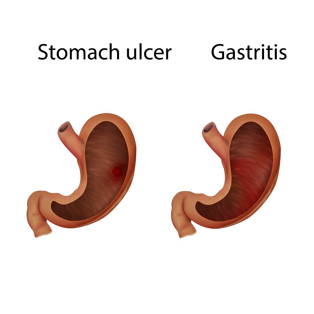 Gastritis and stomach ulcer, illustration
