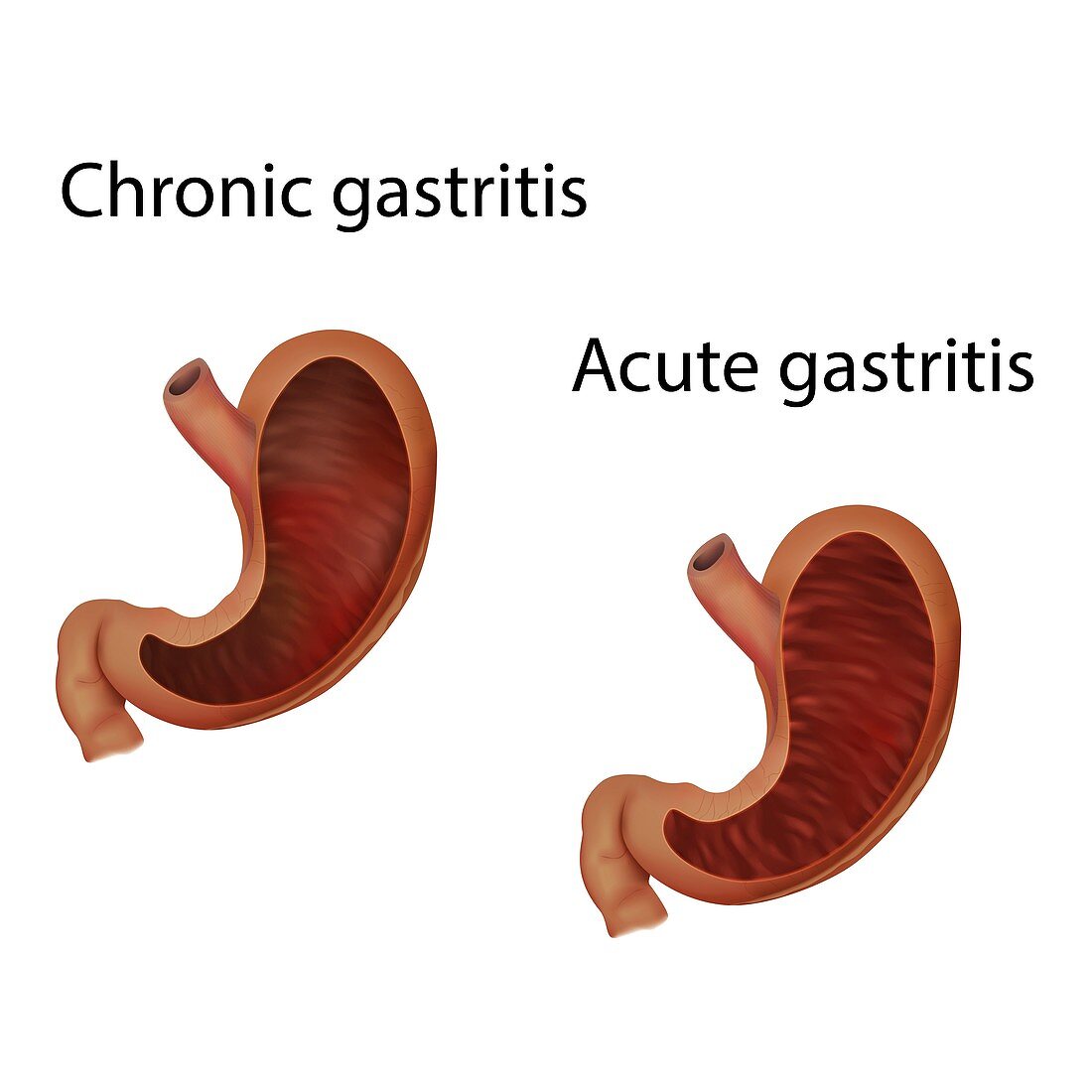 Chronic and acute gastritis, illustration