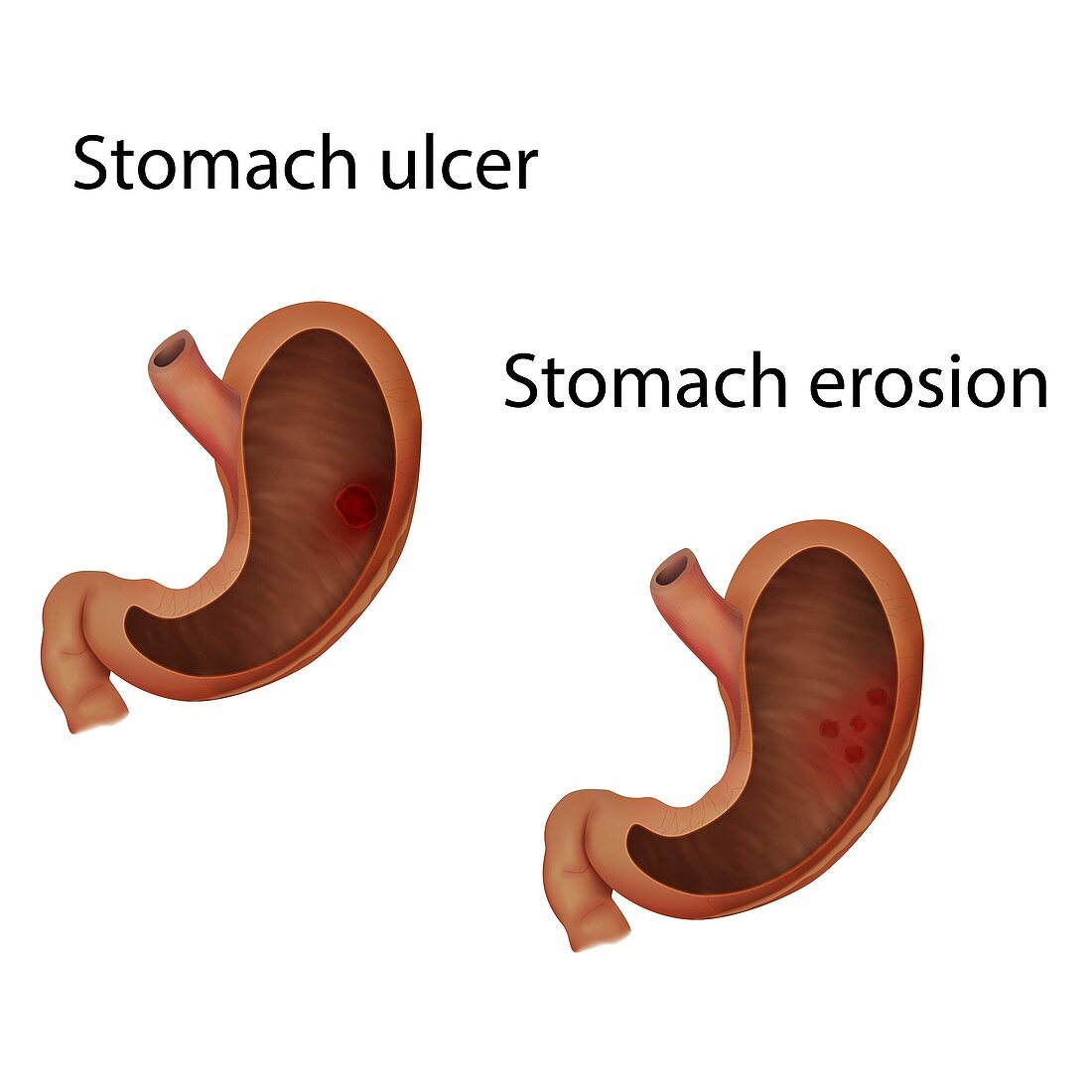 Stomach ulcer and stomach erosion, illustration