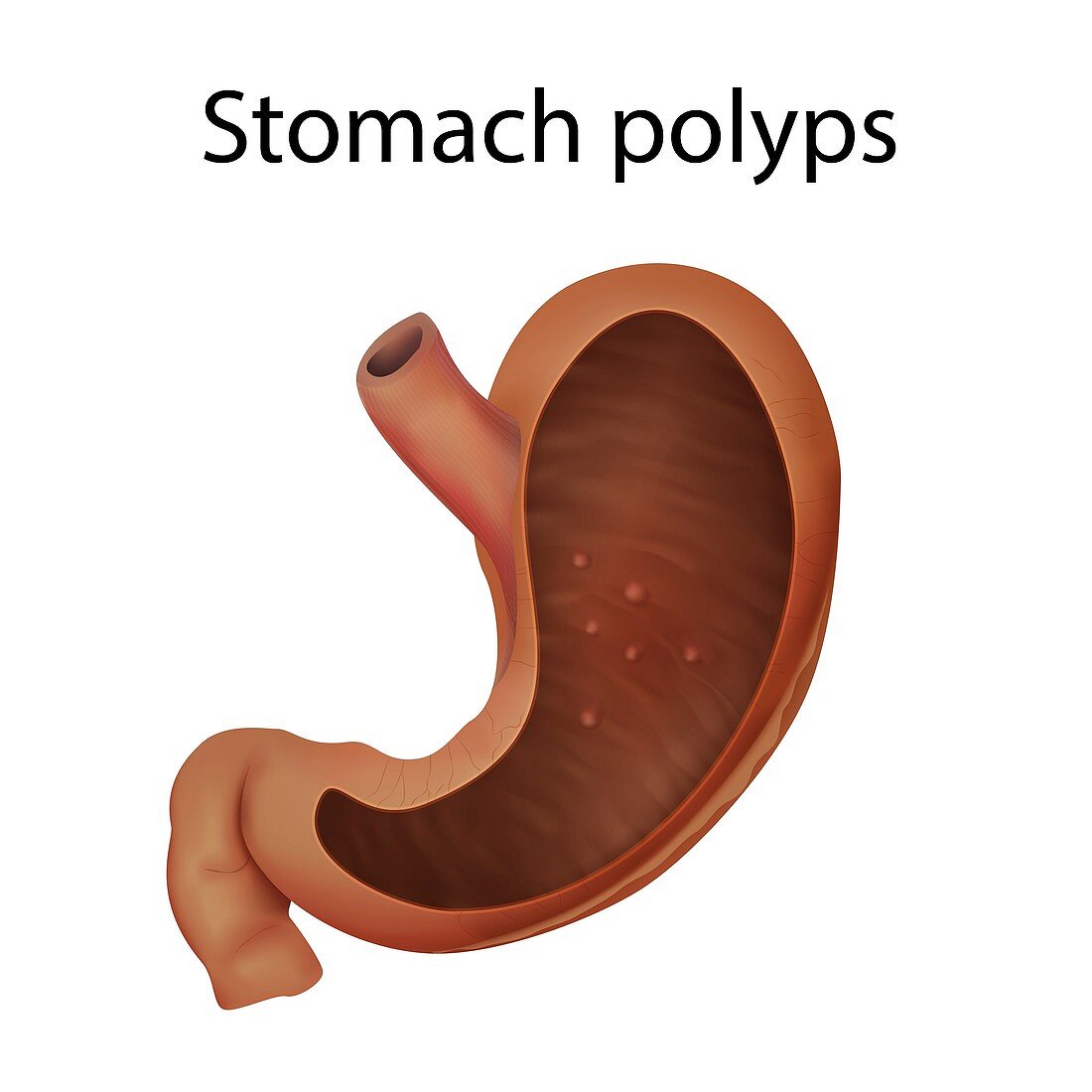 Stomach polyps, illustration