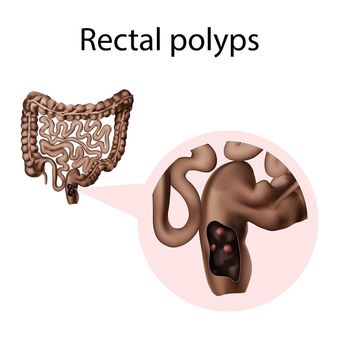 Rectal polyps, illustration