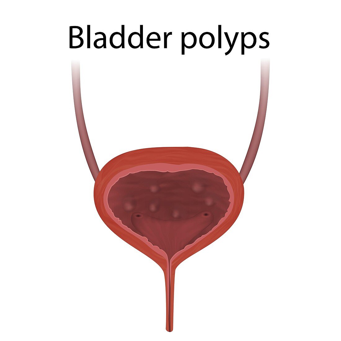 Bladder polyps, illustration