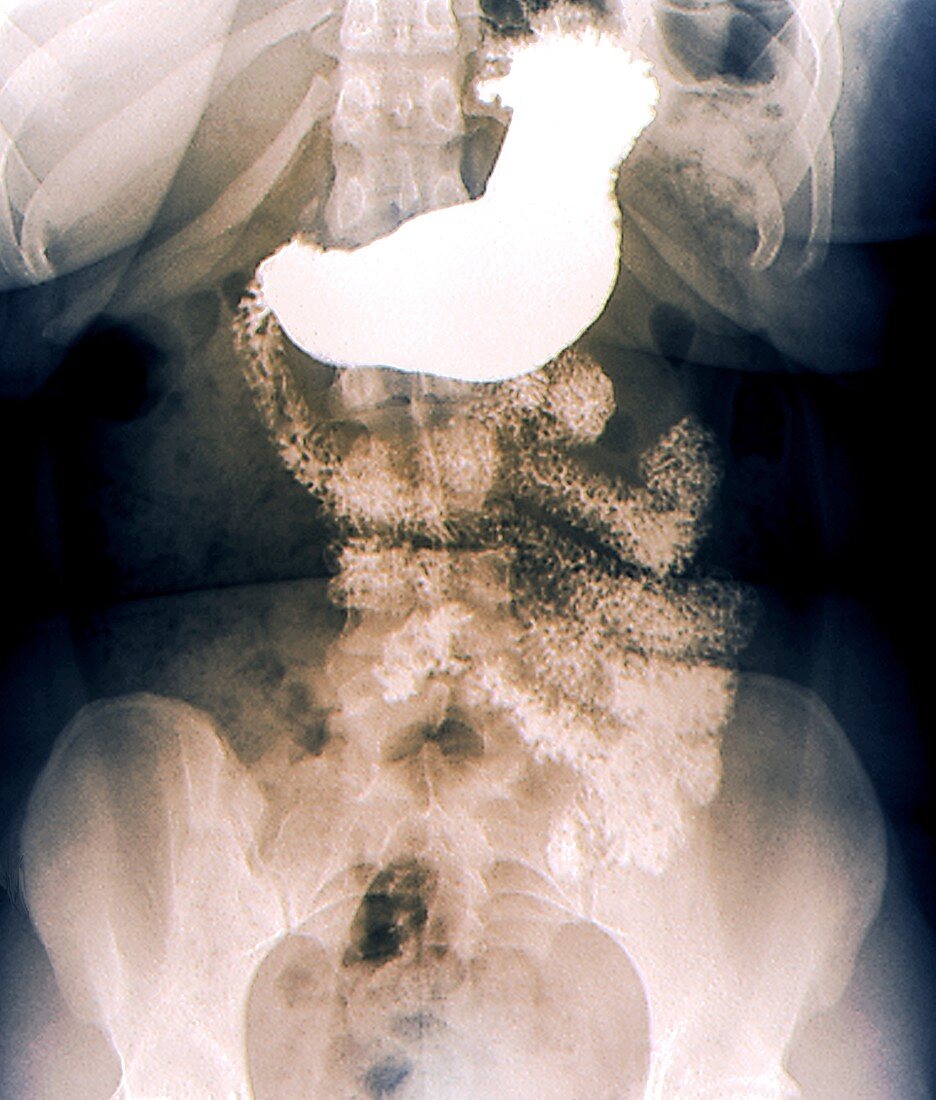 Stomach in bariatric surgery,X-ray