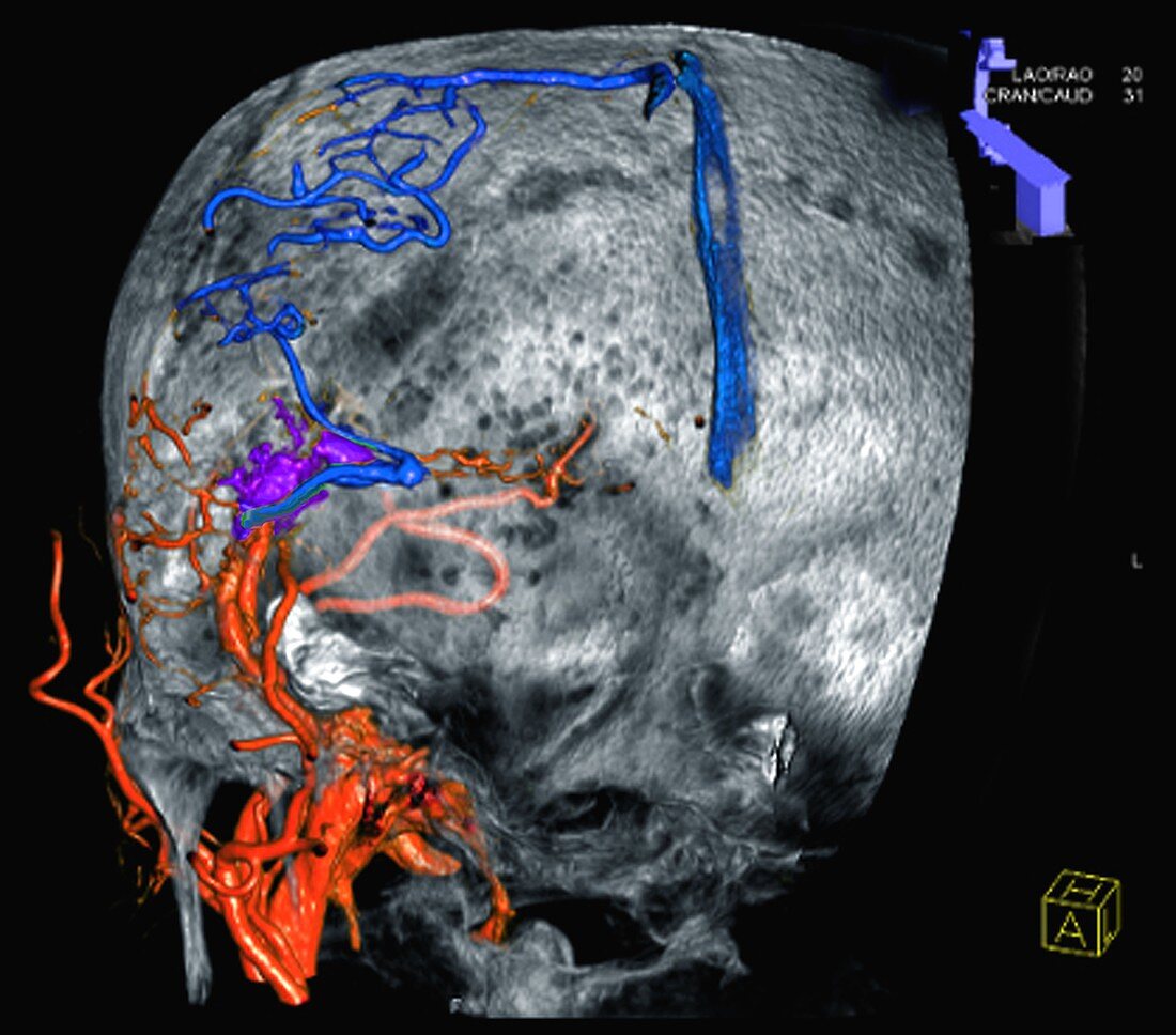 Arterial malformation,3D CT scan