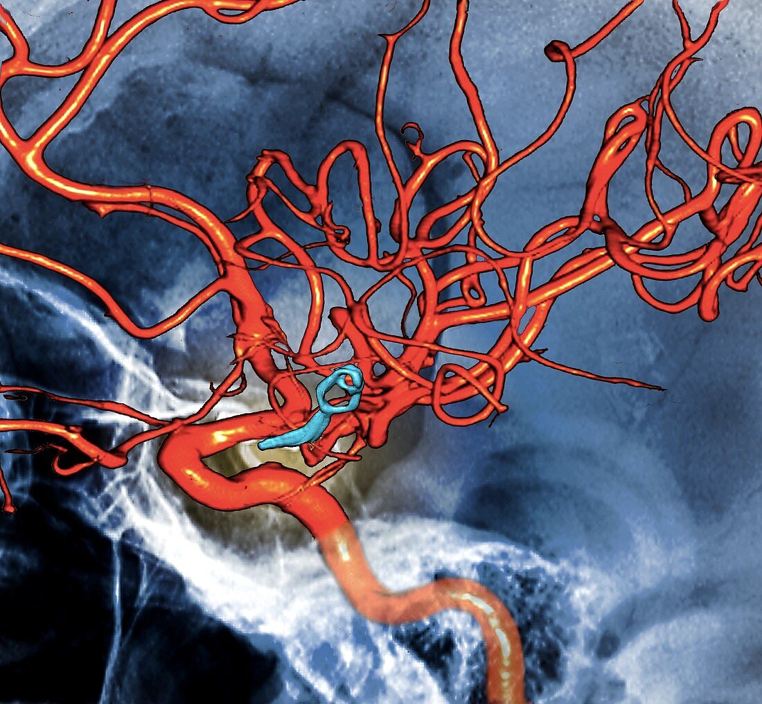 Cerebral aneurysm treatment,3D CT angiogram