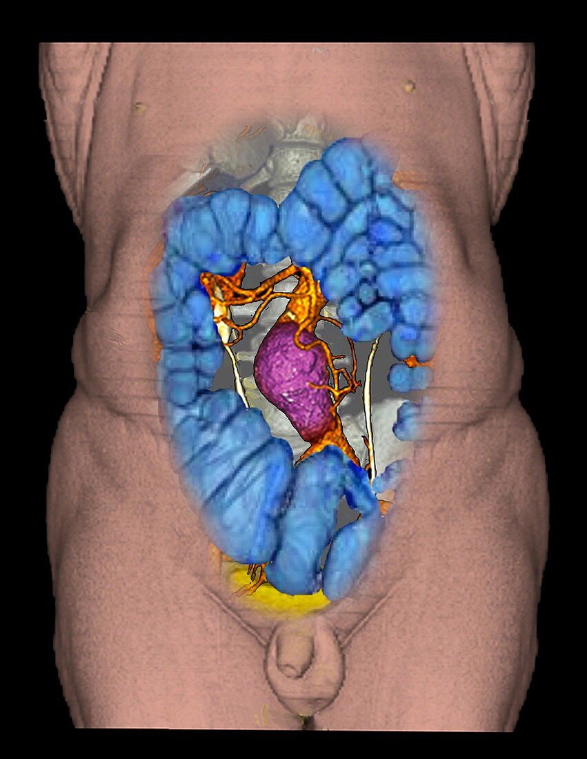 Aortic aneurysm near kidneys,3D CT scan