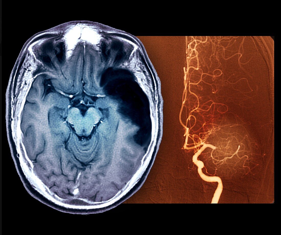 Stroke,MRI brain scan