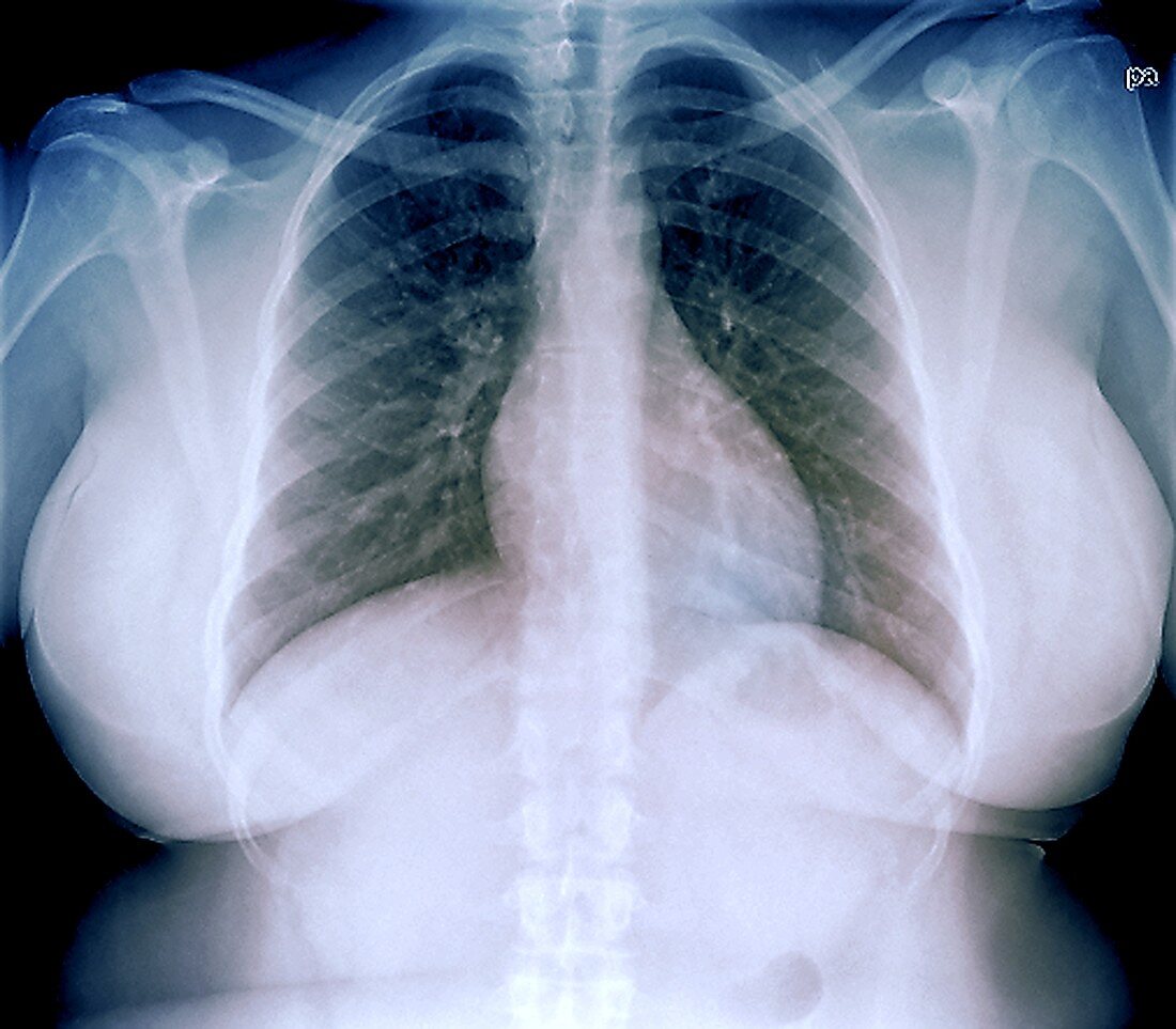 Heart and lungs in obesity,chest X-ray