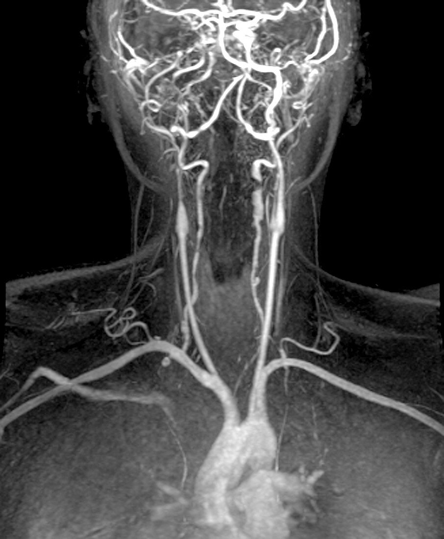 Cervical artery dissections,MRI angiogram