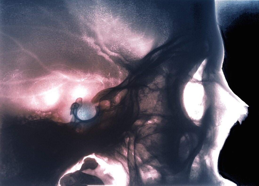 Pituitary gland location,X-ray