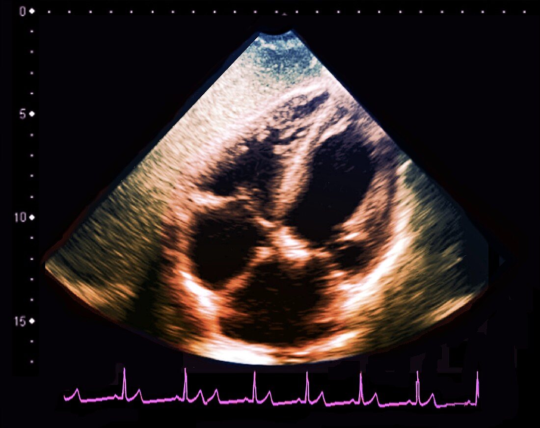 Normal heart,ultrasound scan