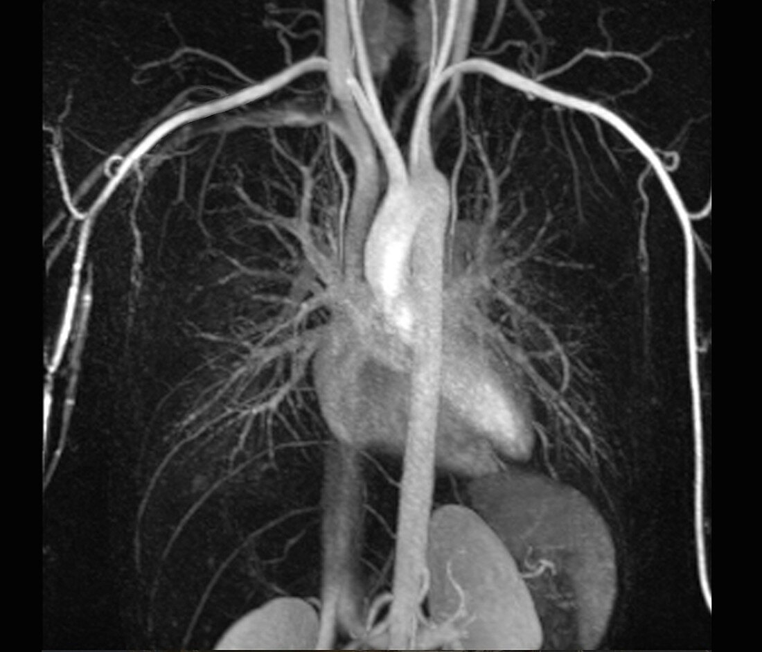 Heart and torso blood vessels,MRI angiogram