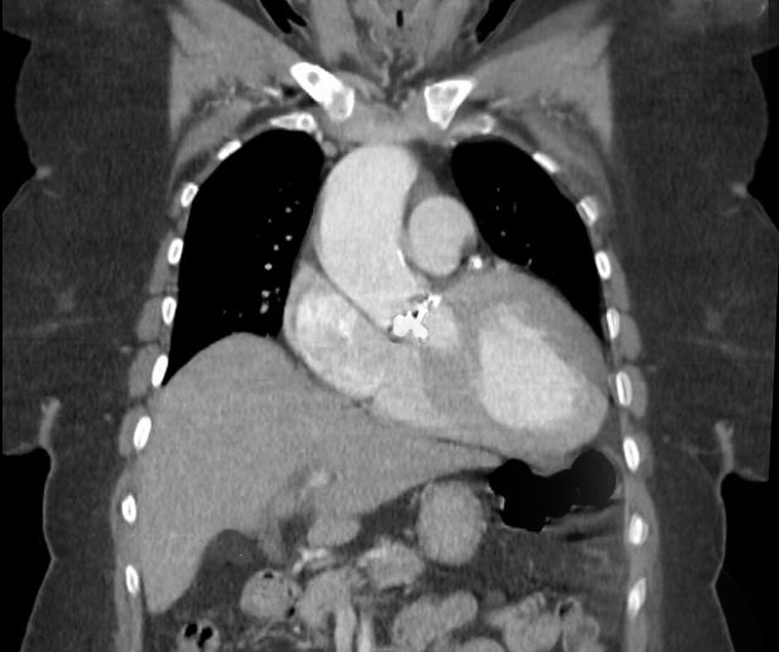 Aortic dilation,coronal CT scan