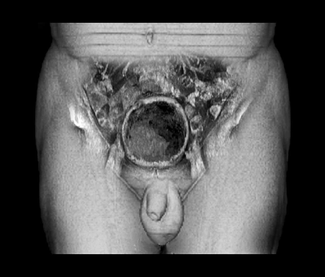 Possible bladder cancer,3D CT scan