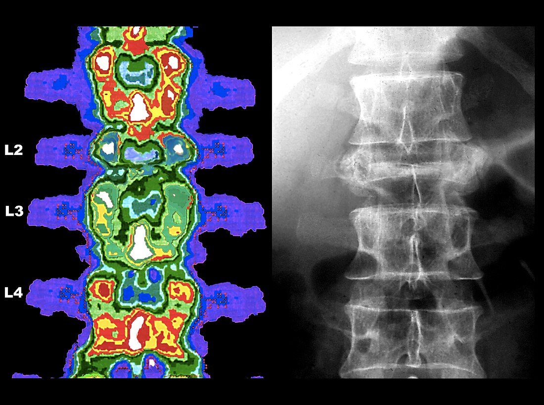Bone demineralisation,densitometry scan and X-ray