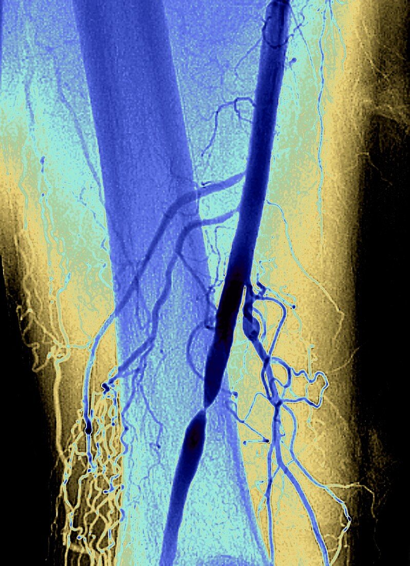 Nearly blocked femoral artery,angiogram