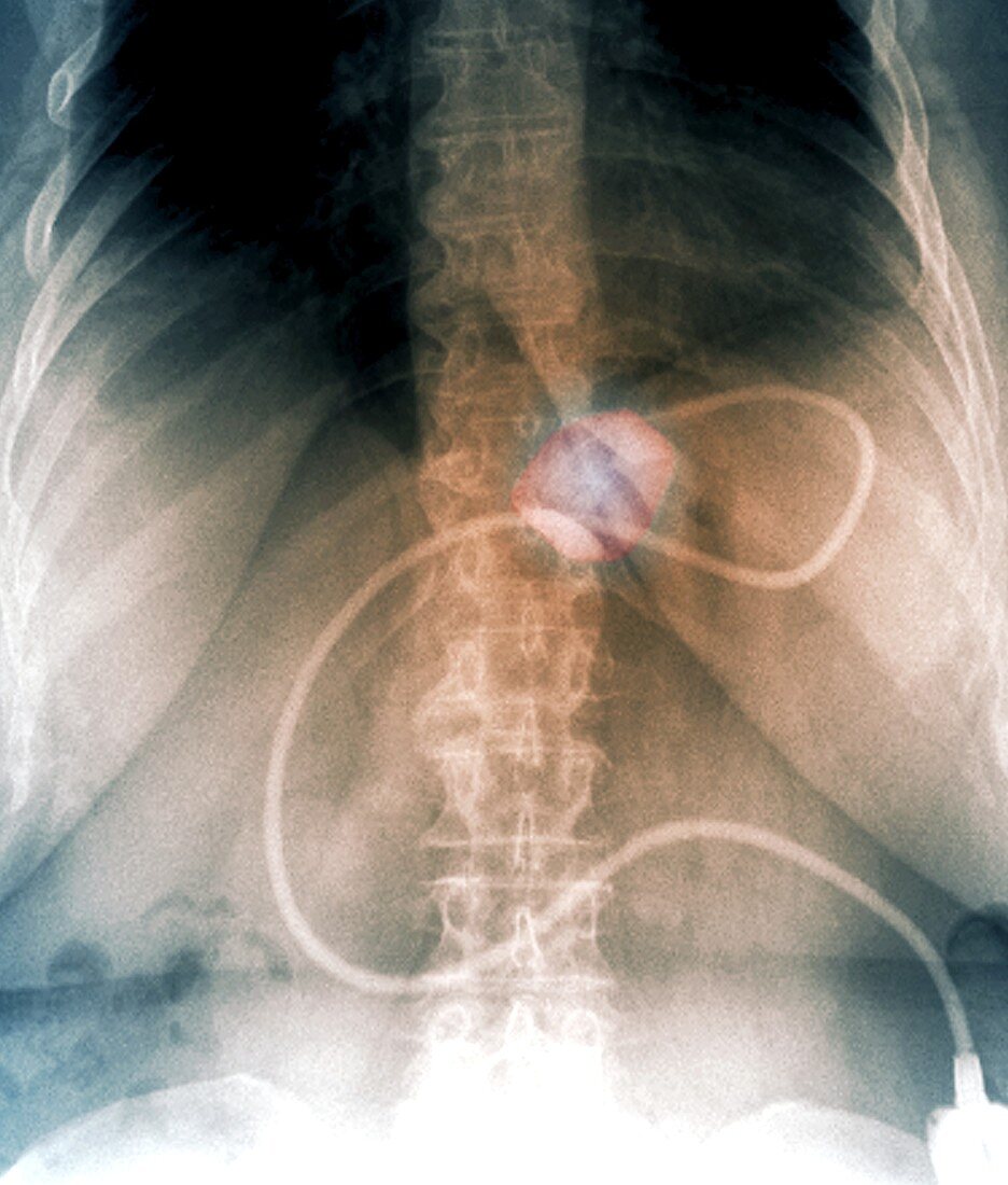 Gastric band treatment for obesity,X-ray