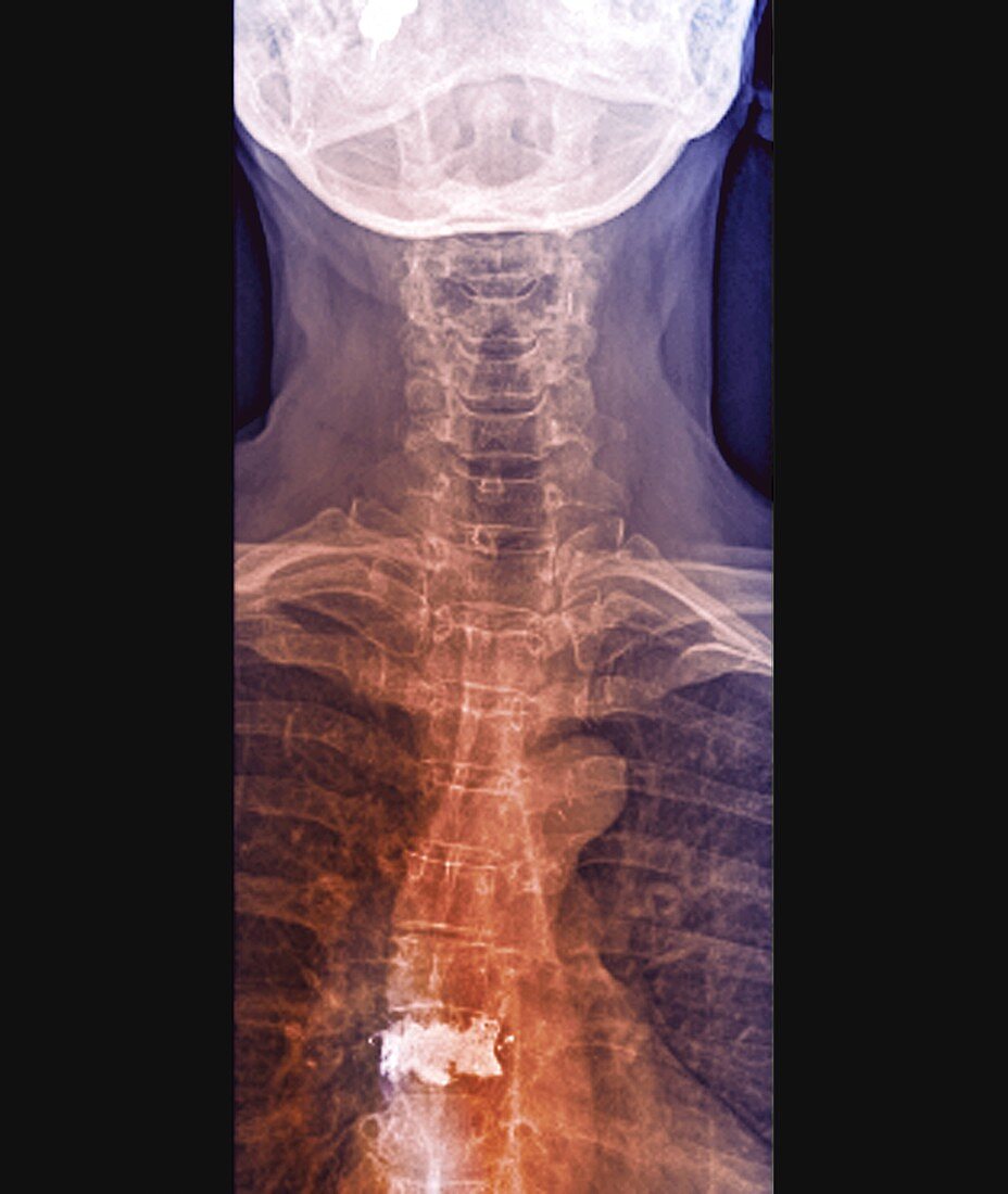 Osteoporosis of the spine with vertebroplasty,X-ray