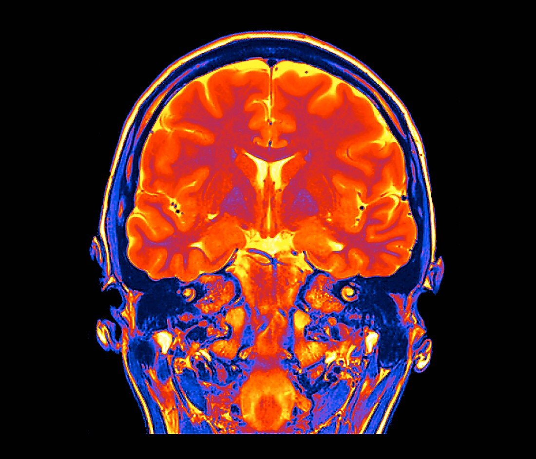 Human brain,coronal MRI scan