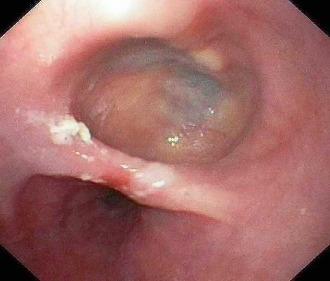 Oesophageal diverticulum,endoscopy image
