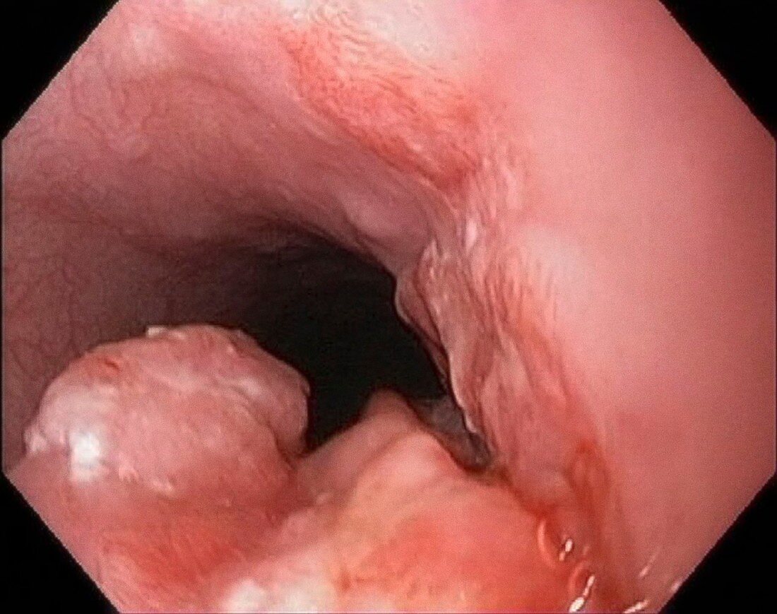 Oesophageal cancer,endoscopy image