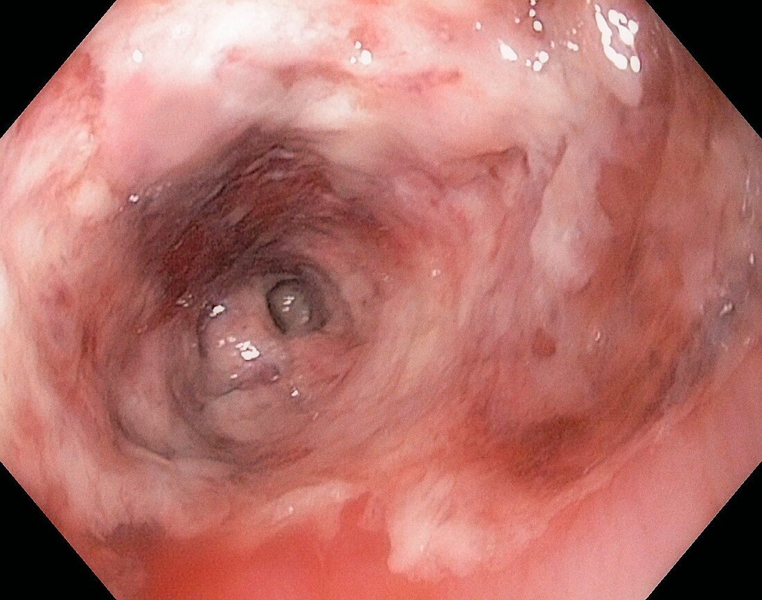Corrosive oesophagitis,endoscopy image